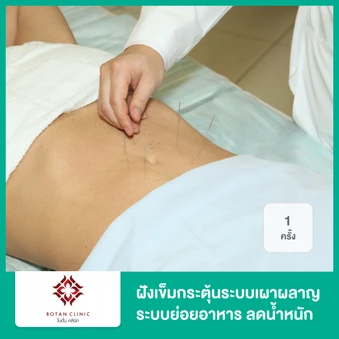 ฝังเข็มกระตุ้นระบบเผาผลาญ ระบบย่อยอาหาร ลดน้ำหนัก กระชับสัดส่วน 1 ครั้ง ฟรี! ของแถม 5 รายการ