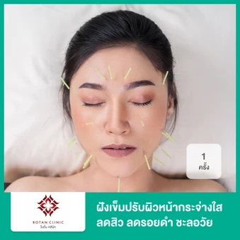 ฝังเข็มปรับผิวหน้ากระจ่างใส ลดสิว ลดรอยดำ ชะลอวัย กระตุ้นให้ผิวหน้าแข็งแรง 1 ครั้ง ฟรี! ของแถม 3 รายการ