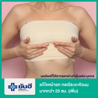 ค่าใช้จ่ายเพิ่มเติมกระชับหน้าอก กรณีระยะหัวนมมากกว่า 25 ซม. หรือน้ำหนักตัวมากกว่า 70 กก. (เพิ่มจากแพ็กเกจหลัก)
