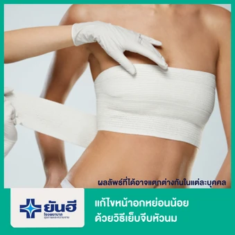 แก้ไขหน้าอกหย่อนน้อย ด้วยวิธีเย็บจีบหัวนม