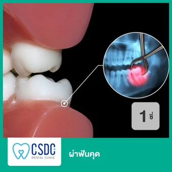 ผ่าฟันคุด 1 ซี่ เฉพาะสาขาลาดพร้าวเท่านั้น