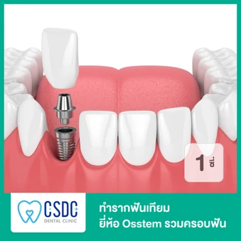 ทำรากฟันเทียม ยี่ห้อ Osstem รวมครอบฟัน 1 ซี่