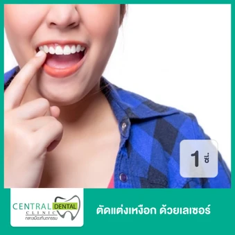 ตัดแต่งเหงือก ด้วยเลเซอร์ สำหรับฟัน 1 ซี่