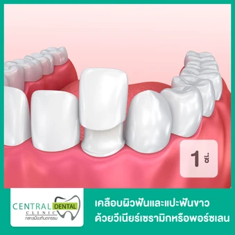 เคลือบผิวฟันและแปะฟันขาว ด้วยวีเนียร์เซรามิกหรือพอร์ซเลน E.Max 1 ซี่