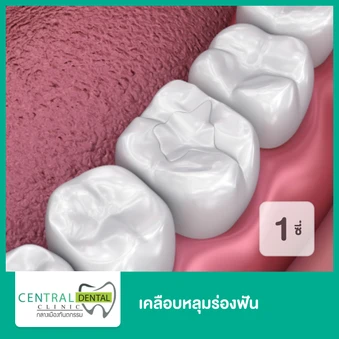 เคลือบหลุมร่องฟัน สำหรับฟัน 1 ซี่
