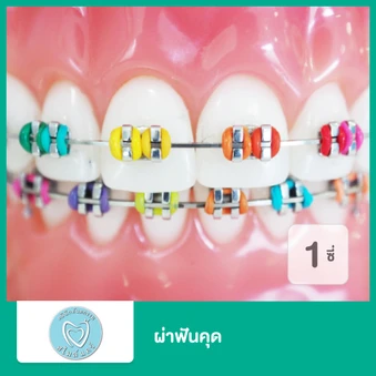 ผ่าฟันคุด 1 ซี่