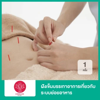 ฝังเข็มบรรเทาอาการเกี่ยวกับระบบย่อยอาหาร 1 ครั้ง