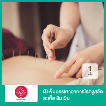 ฝังเข็มบรรเทาอาการโรคงูสวัด สะเก็ดเงิน ผื่น 1 ครั้ง