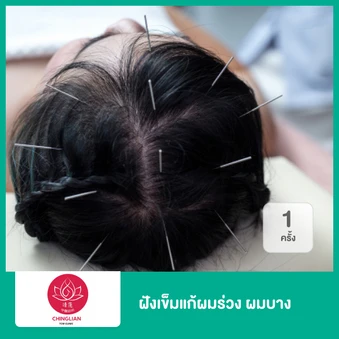 ฝังเข็มแก้ผมร่วง ผมบาง 1 ครั้ง
