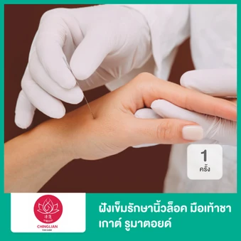 ฝังเข็มรักษานิ้วล็อค มือเท้าชา เกาต์ รูมาตอยด์ 1 ครั้ง