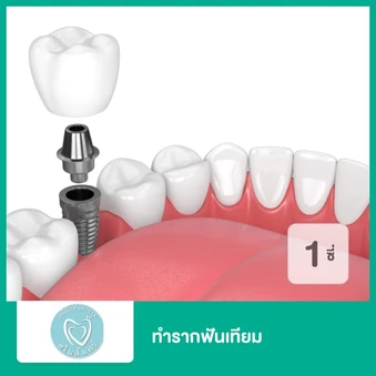 ทำรากฟันเทียม ยี่ห้อ Osstem สำหรับฟัน 1 ซี่