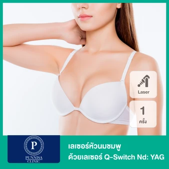 เลเซอร์หัวนมชมพู​ ด้วยเลเซอร์ Q-Switch​ Nd: YAG 1 ครั้ง