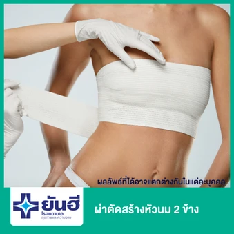 ผ่าตัดสร้างหัวนม (Nipple Reconstruction) 2 ข้าง