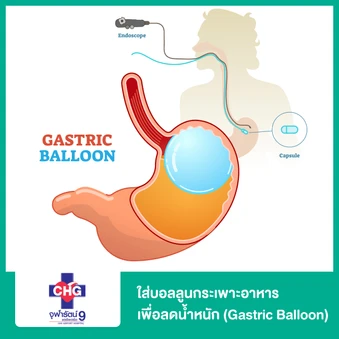 ใส่บอลลูนกระเพาะอาหารเพื่อลดน้ำหนัก (Gastric Balloon)