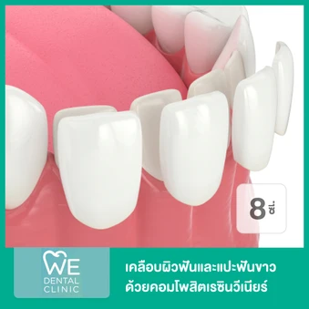 เคลือบผิวฟันและแปะฟันขาว ด้วยคอมโพสิตเรซินวีเนียร์ 8 ซี่