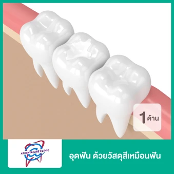 อุดฟัน ด้วยวัสดุสีเหมือนฟัน 1 ด้าน