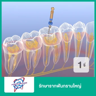รักษารากฟันกรามใหญ่ 1 ซี่