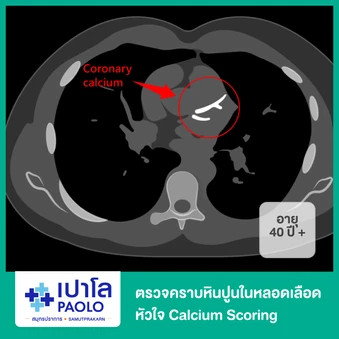 ตรวจคราบหินปูนในหลอดเลือดหัวใจ Calcium Scoring สำหรับผู้ที่อายุ 40 ปีขึ้นไป