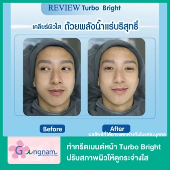 ทำทรีตเมนต์หน้า Turbo Bright ปรับสภาพผิวให้ดูกระจ่างใส 1 ครั้ง