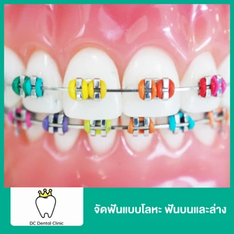 จัดฟันแบบโลหะ ฟันบนและล่าง