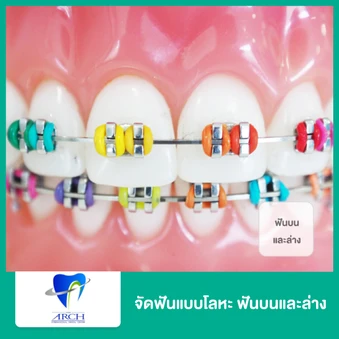 จัดฟันแบบโลหะ ฟันบนและล่าง