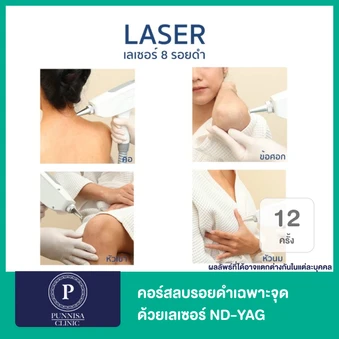 คอร์สลบรอยดำเฉพาะจุด ด้วยเลเซอร์ ND-YAG 1 จุด 12 ครั้ง ภายใน 1 ปี