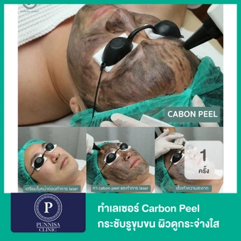ทำเลเซอร์ Carbon Peel กระชับรูขุมขน ผิวดูกระจ่างใส 1 ครั้ง