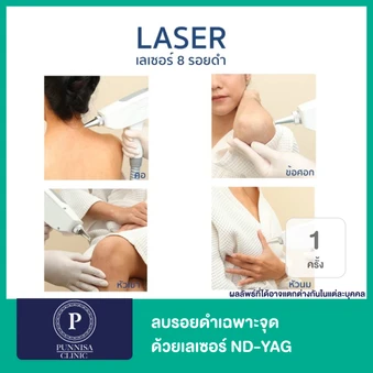 ลบรอยดำเฉพาะจุด ด้วยเลเซอร์ ND-YAG 1 จุด 1 ครั้ง