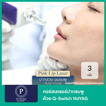 เลเซอร์ปากชมพู ด้วย Q-switch Nd:YAG 3 ครั้ง