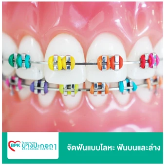 จัดฟันแบบโลหะ ฟันบนและล่าง