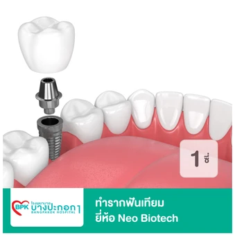 ทำรากฟันเทียม ยี่ห้อ Neo Biotech สำหรับฟัน 1 ซี่