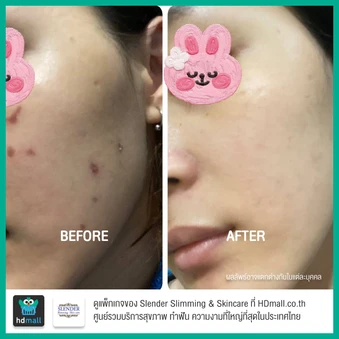 เลเซอร์ Q-Switch Nd: YAG Laser ปรับสภาพผิวให้ดูกระจ่างใส ลดรอยฝ้า กระ จุดด่างดำ บริเวณใบหน้า ครั้งละ 100 ช็อต 3 ครั้ง ที่ Slender Slimming & Skincare