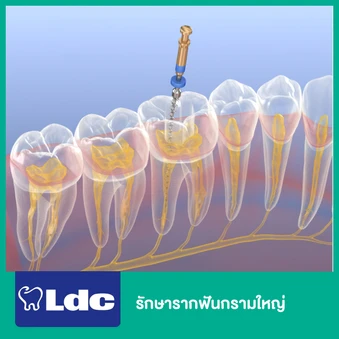 รักษารากฟันกรามใหญ่