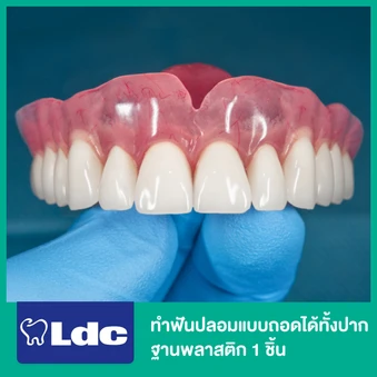 ทำฟันปลอมแบบถอดได้ทั้งปาก ฐานพลาสติก 1 ชิ้น ฟันบนหรือล่าง