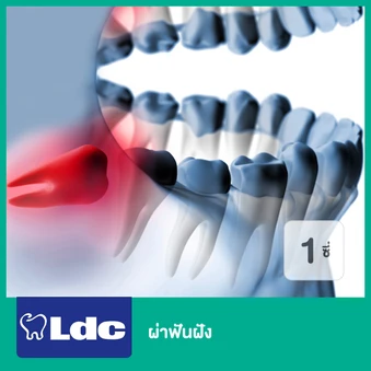 ผ่าฟันฝัง 1 ซี่