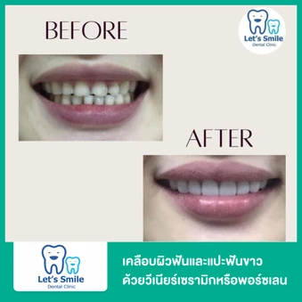 เคลือบผิวฟันและแปะฟันขาว ด้วยวีเนียร์เซรามิกหรือพอร์ซเลน 1 ซี่