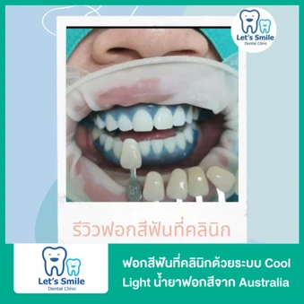 ฟอกสีฟันในคลินิกด้วยระบบ Cool Light น้ำยาฟอกสีนำเข้าจาก Australia