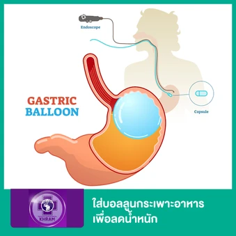 ใส่บอลลูนกระเพาะอาหารเพื่อลดน้ำหนัก (Gastric Balloon)