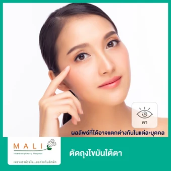 ตัดถุงไขมันใต้ตา 1 ครั้ง