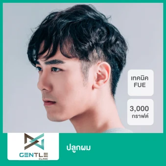 ปลูกผม ด้วยเทคนิค FUE 3,000 กราฟต์