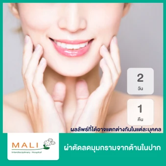 ผ่าตัดลดมุมกรามจากด้านในปาก นอนพักที่ รพ. 2 วัน 1 คืน