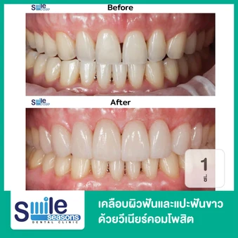 เคลือบผิวฟันและแปะฟันขาว ด้วยวีเนียร์คอมโพสิต 1 ซี่