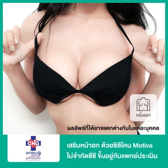 เสริมหน้าอก ด้วยซิลิโคน Motiva ไม่จำกัดซีซี ขึ้นอยู่กับแพทย์ประเมิน สำหรับเคสทำครั้งแรก