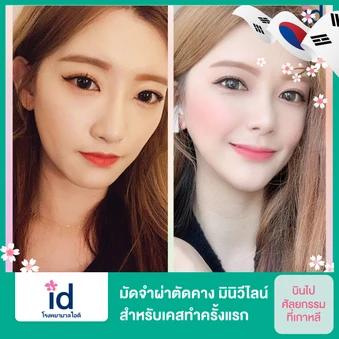 มัดจำผ่าตัดคาง มินิวีไลน์ (Mini V-Line) สำหรับเคสทำครั้งแรก