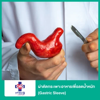 ผ่าตัดกระเพาะอาหารเพื่อลดน้ำหนัก (Gastric Sleeve)
