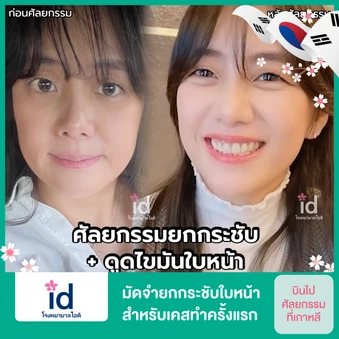 มัดจำยกกระชับใบหน้า สำหรับเคสทำครั้งแรก