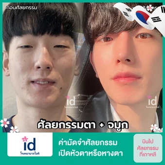 ค่ามัดจำศัลยกรรมเปิดหัวตาหรือหางตา สำหรับเคสทำครั้งแรก