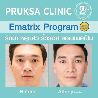 เลเซอร์ E-Matrix แก้ปัญหาหลุมสิว ผิวขรุขระ รูขุมขนกว้าง 100 ช็อต 1 ครั้ง