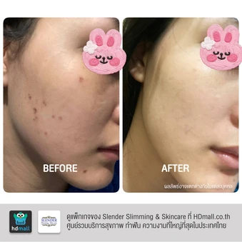 คอร์สฉายแสงฆ่าเชื้อสิว ด้วย Blue Light Laser ลดการอักเสบ ทำให้สิวฝ่อและแห้งลง 2 ครั้ง