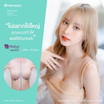 เสริมหน้าอก ด้วยซิลิโคน Motiva Ergonomix2 จำนวนซีซีขึ้นอยู่กับแพทย์ประเมิน สำหรับเคสทำครั้งแรกหรือเคสแก้
